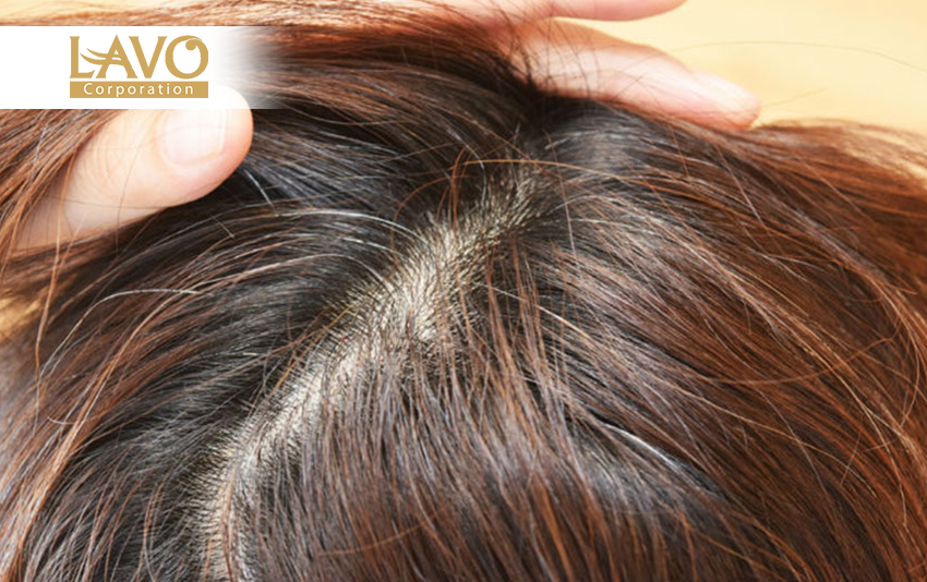 Nguyên Nhân Tóc Bạc Sớm