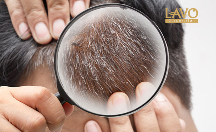 6 Nguyên Nhân Khiến Tóc Bạc Sớm