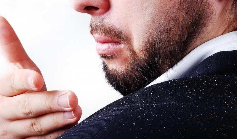 Gel vuốt tóc cũng là một trong những nguyên nhân gây nên gàu