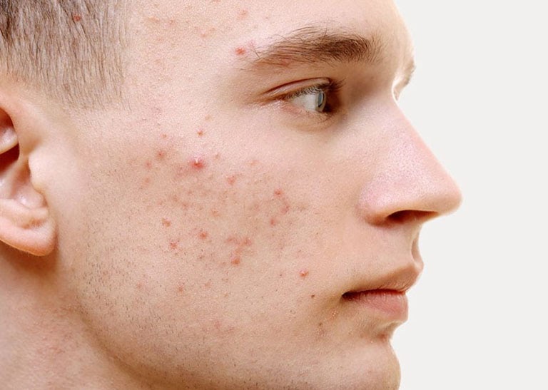 Mụn ở nam giới thường do nội tiết tố gây ra