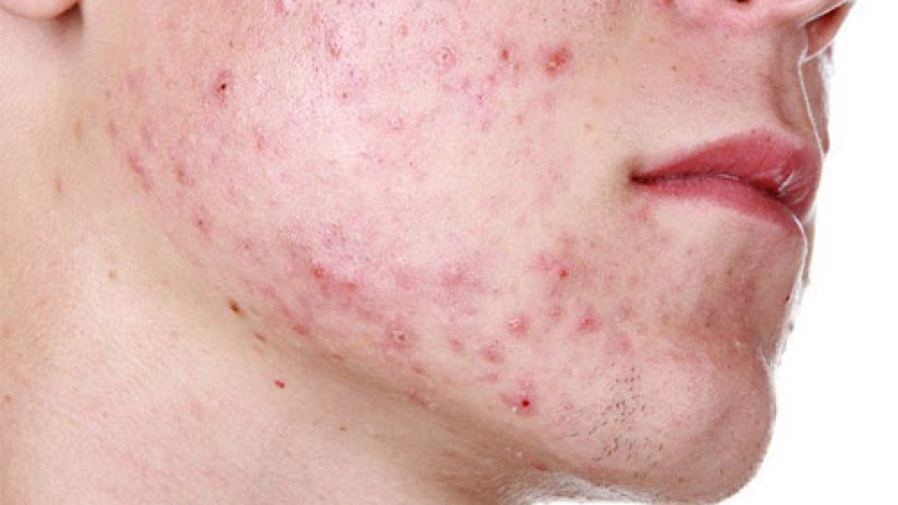 Sữa rửa mặt giúp nam giới ngăn ngừa mụn xuất hiện